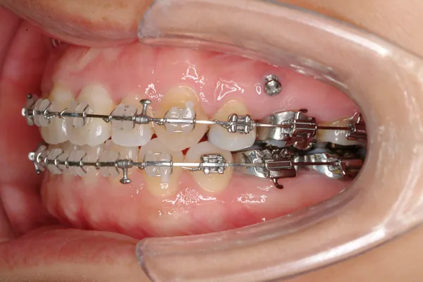 歯科矯正用アンカースクリューを用いた矯正歯科治療
